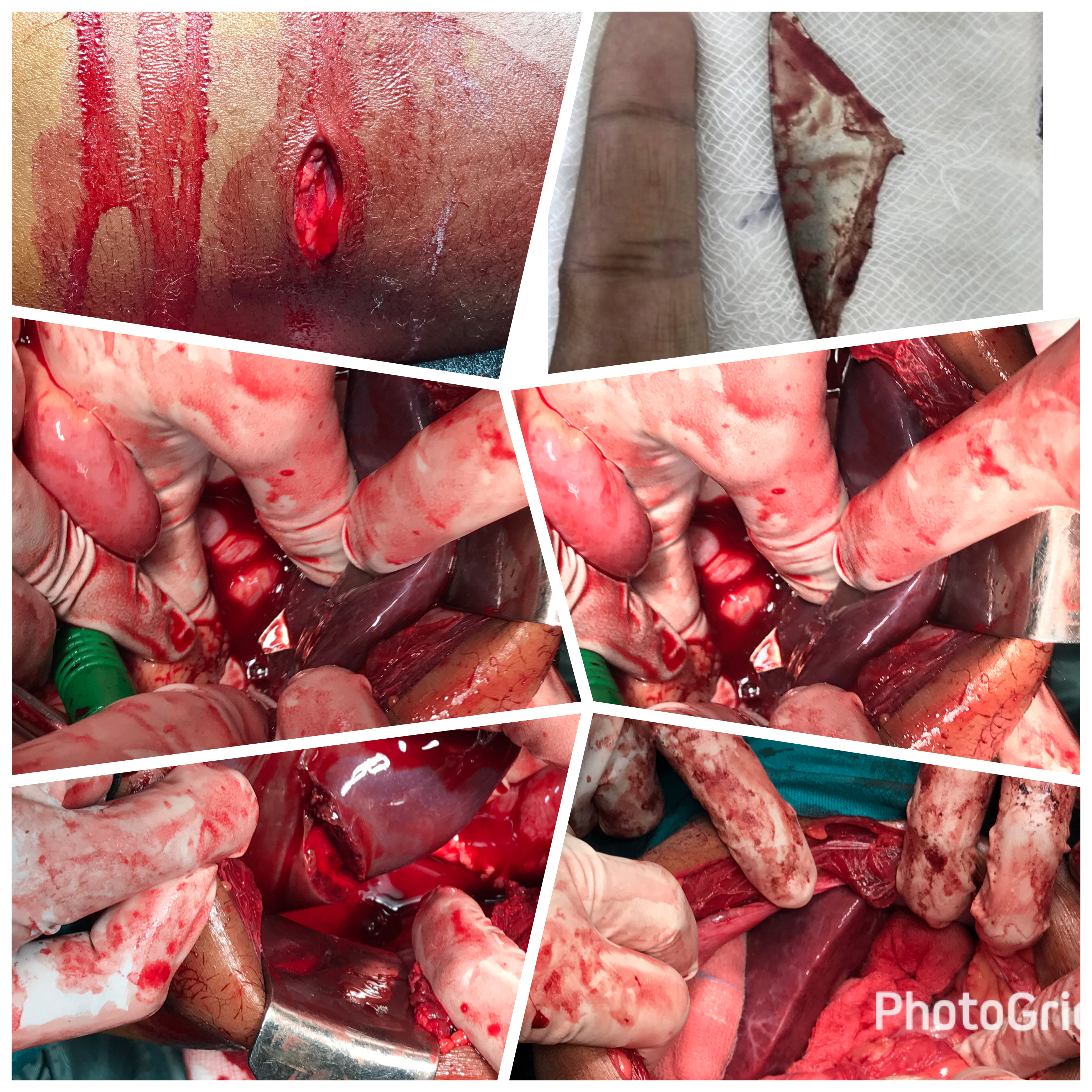 Penetrating Foreign Body Injury To Liver